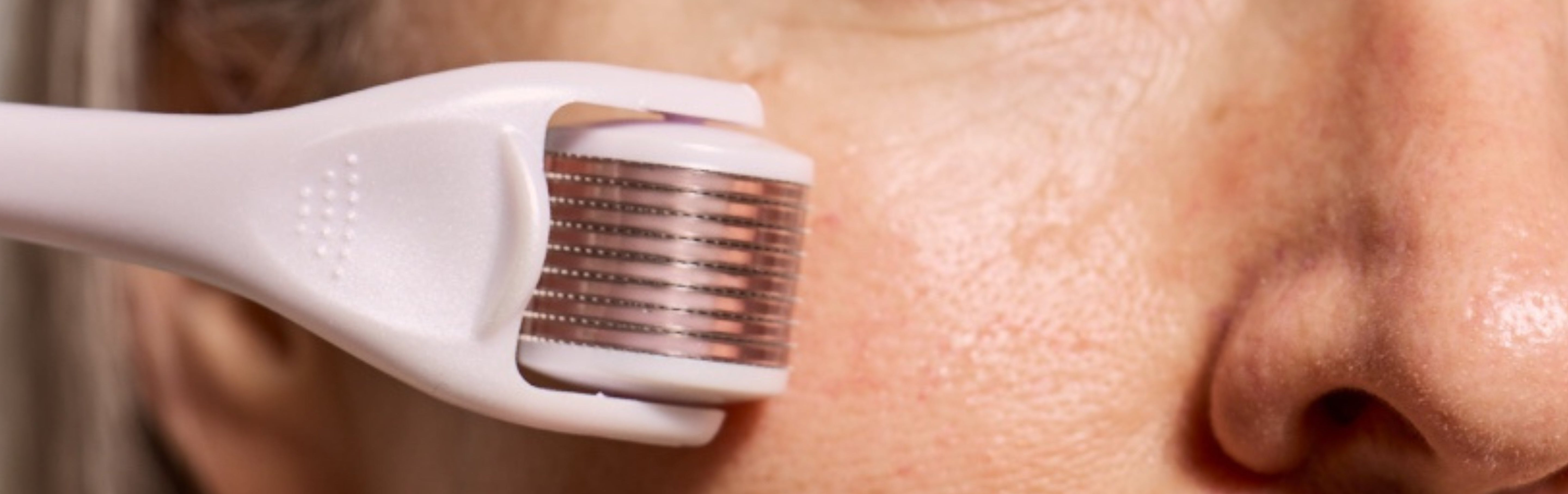 Does Microneedling at Home Really Work?