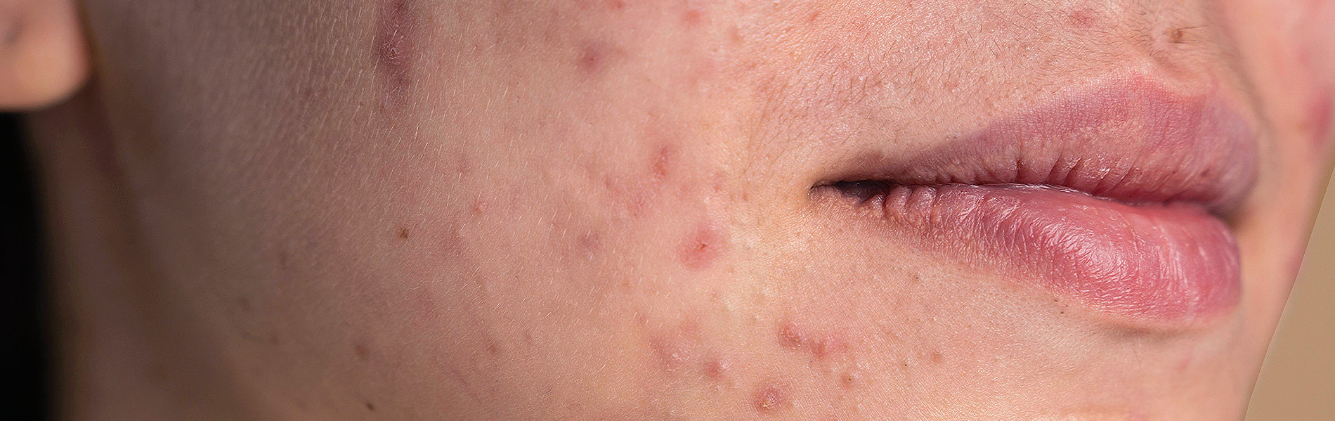 Blue Light Therapy for Psoriasis and Eczema