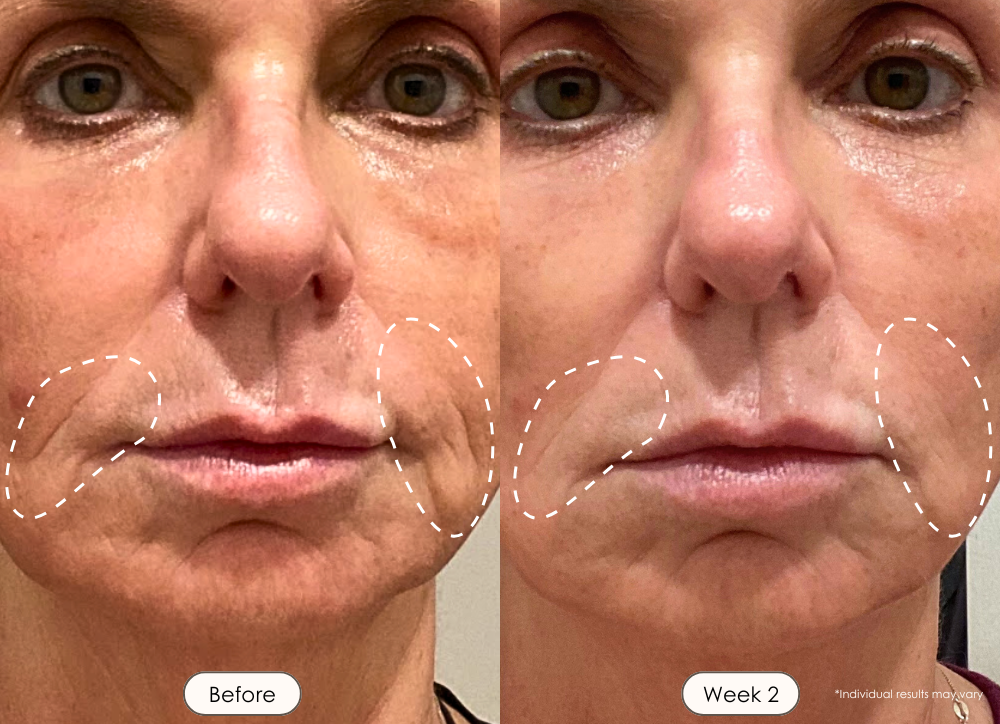 2024-PE745-denell-shopify-before-and-after-red-light-therapy