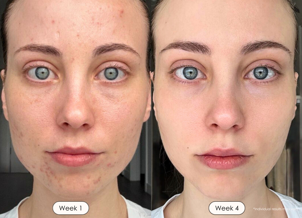 visible results after 30 days of using the LED light therapy mask
