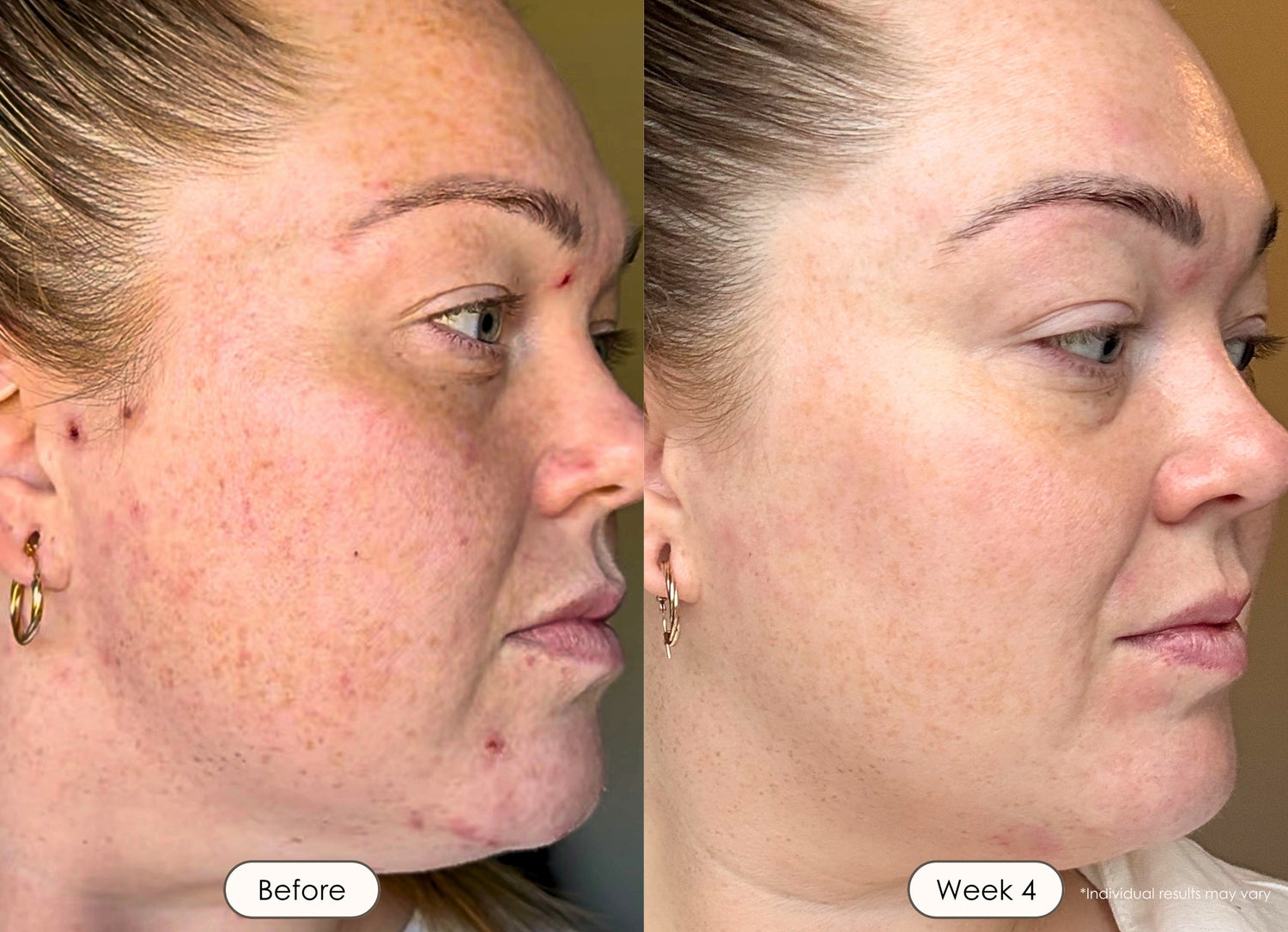 Skin transformation progress photo featuring enhanced glow and even-looking complexion after using LED light therapy.