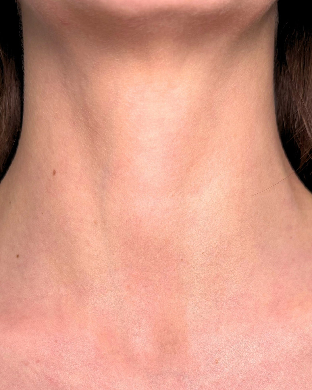 Tetiana's neck after 4 weeks of LumaLux Face+